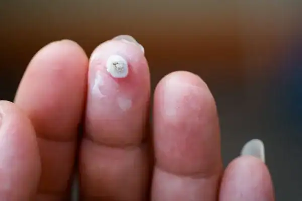 Image of white wart before cryopen treatment Ramsgate