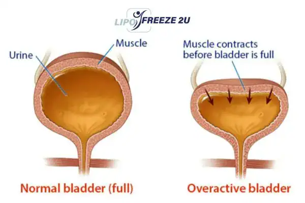 diagram of overactive bladder treatment Ramsgate