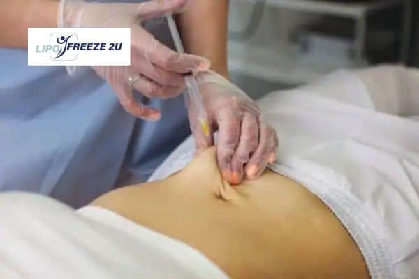 How Does Aqualyx Fat Dissolving Injection Work to Break Down Fat Ramsgate?