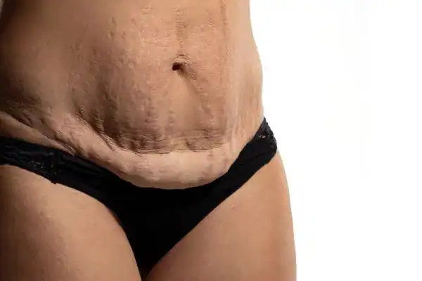 loose skin after weight loss injections Ramsgate