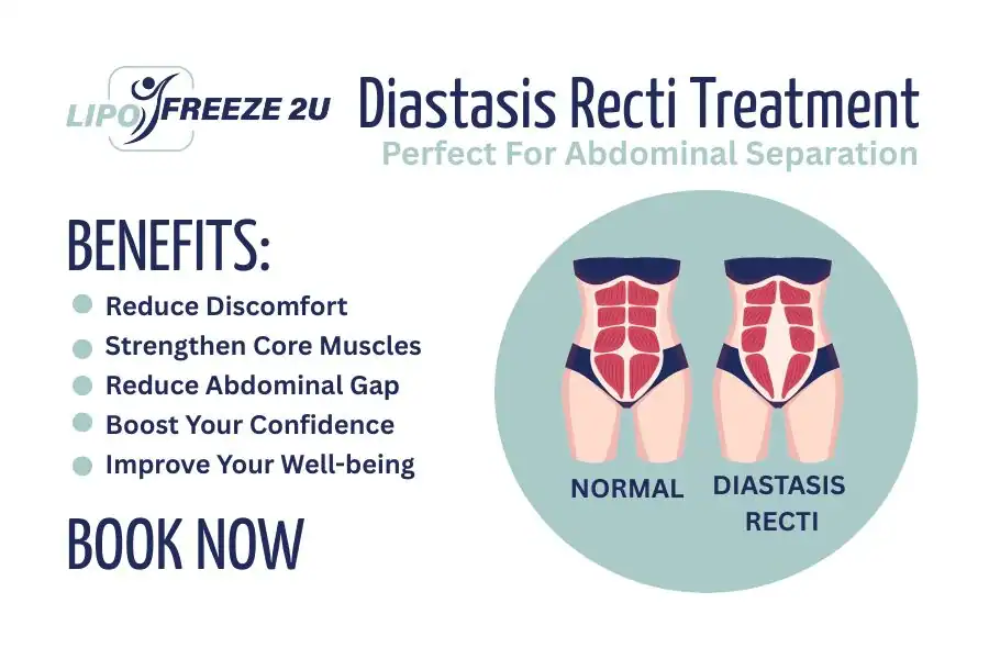 How Long Will It Take to See Improvements in Diastasis Recti Ramsgate