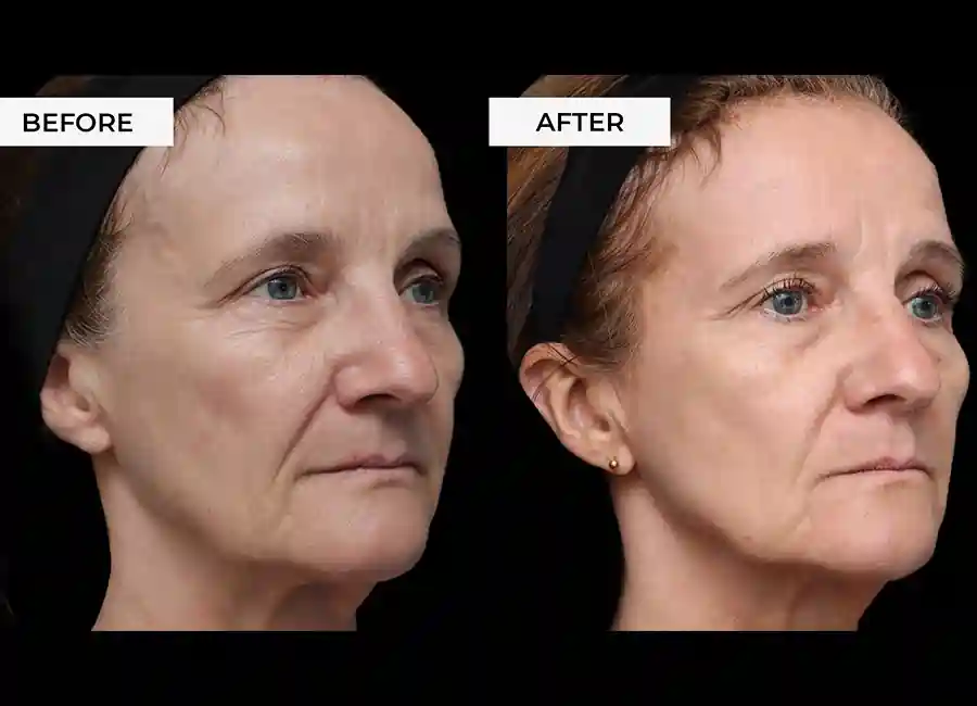 How Many RF Microneedling Sessions Will You Need to See a Difference Ramsgate?