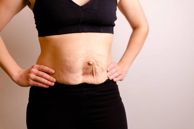 Is Surgery Really the Only Way to Repair Diastasis Recti Ramsgate?