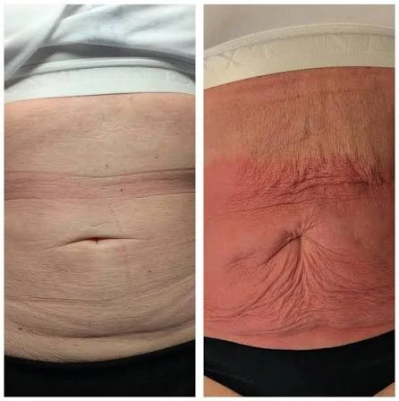 How Does RF Microneedling Improve Crepey, Thin and Uneven Skin Texture Ramsgate?