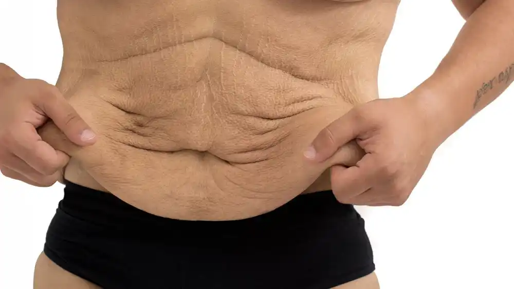 RF Microneedling for Loose Skin: How Can It Help Tighten and Reshape the Skin Ramsgate?